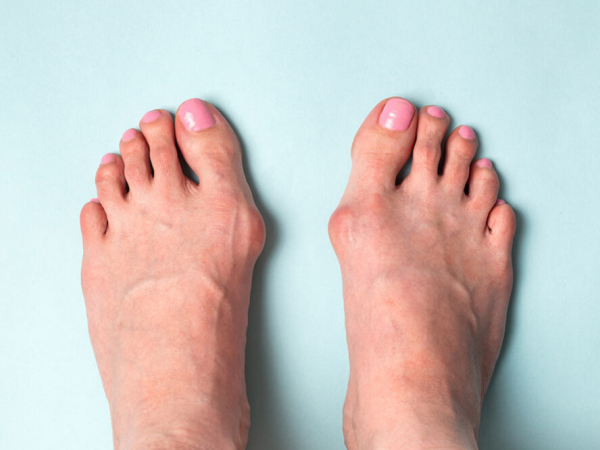 Hallux Valgus